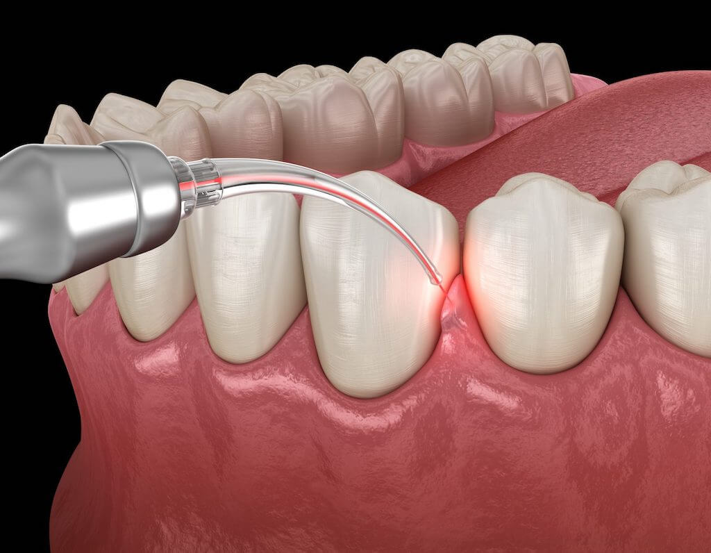 Gum Treatment
