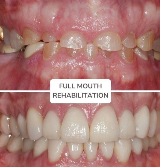 Full Mouth Rehabilitation