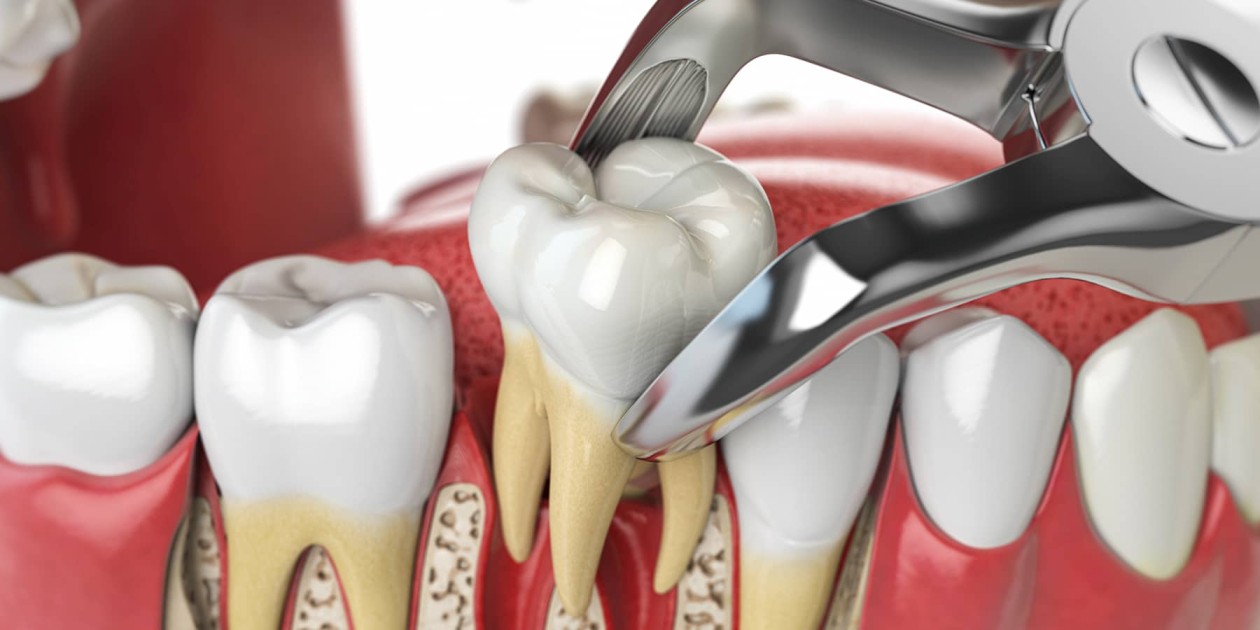 Tooth Extractions