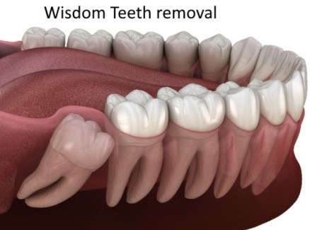Wisdom Tooth Removal